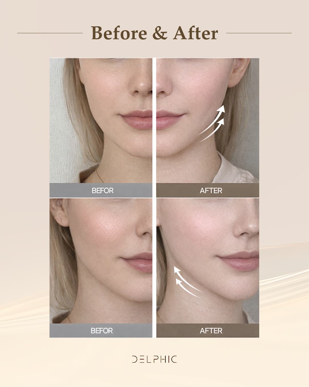 Ultherapy Prime before and after, front view — jawline and cheek lift