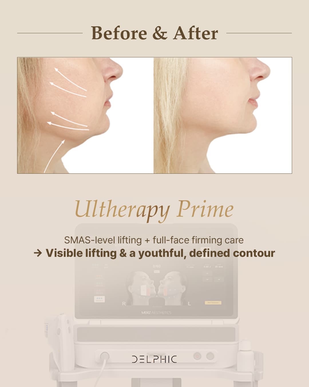 Ultherapy Prime before and after, side view — under-chin and neck lift